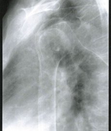 Röntgenbild der Schulter